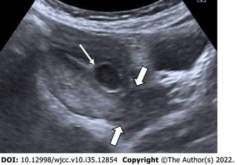 This can be detected using B-mode ultrasound. . Gestational sac lower uterine segment